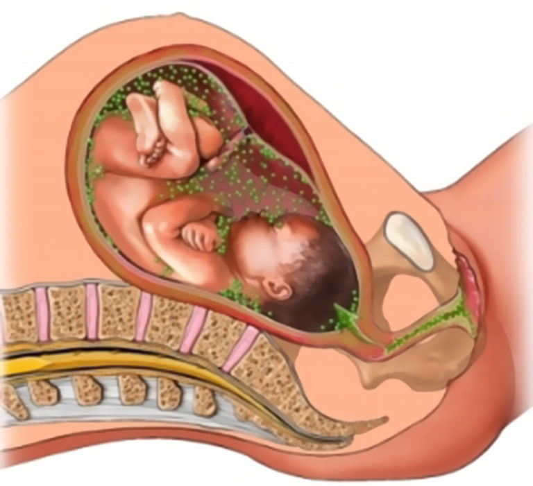 Внутриутробное заражение ЗППП от матери к ребенку