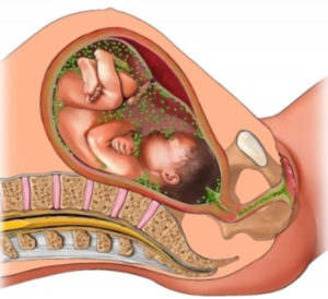Трихомониаз у беременных