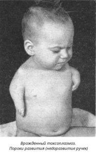 Врожденный токсоплазмоз у ребенка