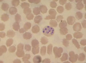 Кровь под микроскопом, где видно зараженную пироплазмозом клетку